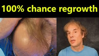 Hair Regrowth, No Fail Method, 100% Success