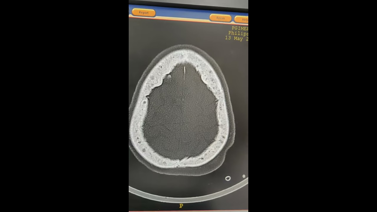 Paget's Disease of Skull on NCCT Head YouTube