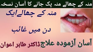 Muh k chalo ka ilaj in urdu /Hindi | Mouth ulcer treatment at home | Muh k chalo ka desi ilaj