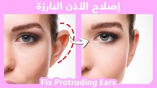 Fix Protruding Ears NATURALLY |  إصلاح الأذن البارزة بشكل طبيعي
