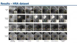 MIDL 2020, P333, Li et al. Teaser