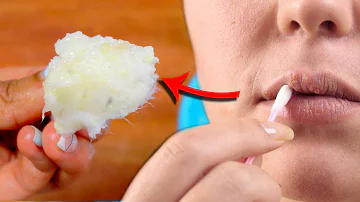 ¿Cómo elimina la vaselina el herpes labial?