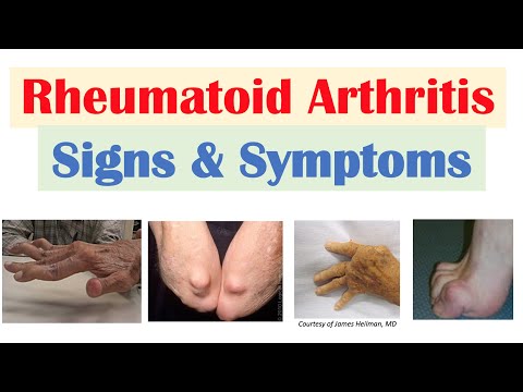 Video: Bolehkah Rheumatoid Arthritis Membunuh Anda? Penyelidikan, Komplikasi & Banyak Lagi