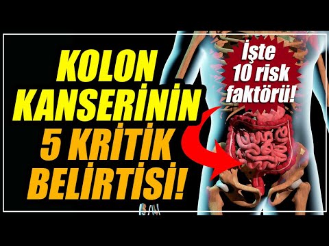 Kolon kanserinin 5 kritik belirtisi! Kolon (Bağırsak) kanseri belirtileri, bağırsak kanseri tedavisi