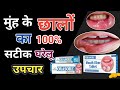 मुँह के छालों के लिए घरेलु रामबाड़ दवाई | 100% कारगर फार्मूला | Orasore Tablet | Orasore Gel In Hindi