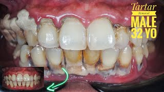 Tartar Removal | Dental Scaling | Karang Gigi Tebal | 32 yo | Male