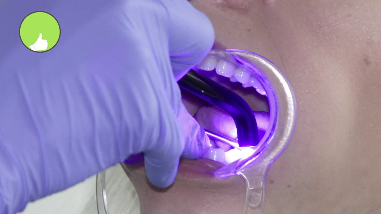 Tips And Tricks On Light Curing YouTube