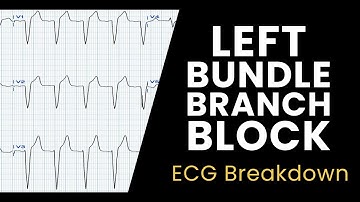 Left Bundle Branch Block | ECG Breakdown