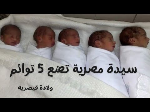 سيدة مصرية تضع 5 توائم بحالة جيدة ولادة قيصرية
