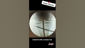 Overcorrection of a medial open wedge high tibial #osteotomy  💥 #orthopedics #knee #kneesurgey