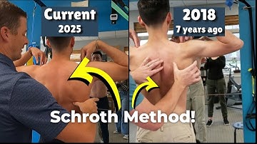 Schroth Method Exercises Explained: Scoliosis 7 Years Later!