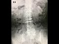 Epidural Anesthesia (Scoliosis) 360-degree view 4K by Dr.EpiCal