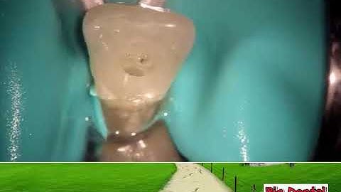 B.D: Mở tủy răng cửa dưới( Carlos praco)