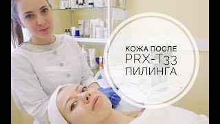 Как делают PRX-T33 пилинг