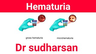 Approach To Hematuria - Types Management- Dr Sudharsan