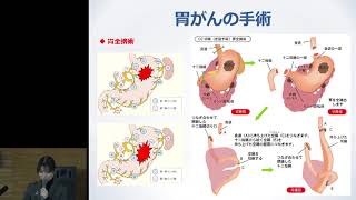 胃がんの手術について　與田幸恵先生：もっと知ってほしい消化器がんのこと2019 in 佐賀