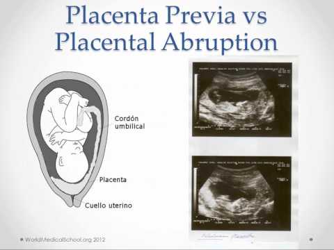 Vaginal Bleeding in Pregnancy - USMLE Step 2 Review