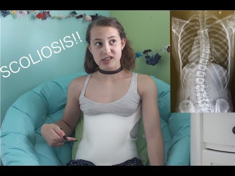 What T Shirts For Scoliosis Brace