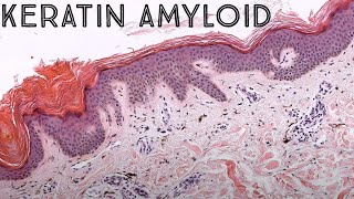 Keratin Amyloid (Lichen amyloid vs Macular amyloidosis) (NOT systemic amyloidosis!) pathology screenshot 4