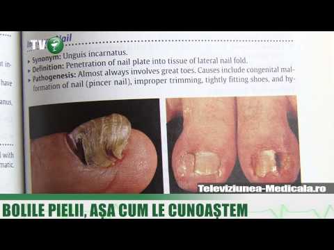 Video: Psoriazisul Unghiilor Vs. Ciuperci: Aflați Semnele