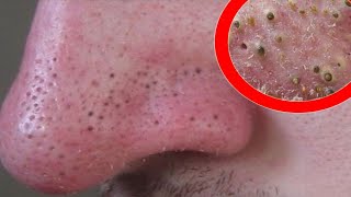 Removes acne, Давим прыщи, чёрные точки. Залипательно🤩