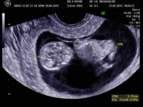 Embarazo 12 semanas 4 dias