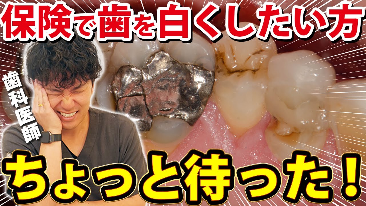 銀歯を保険で白くしたい方必見！コンポジットレジンのメリット・デメリットを歯医者が解説【歯を白くする方法/虫歯】