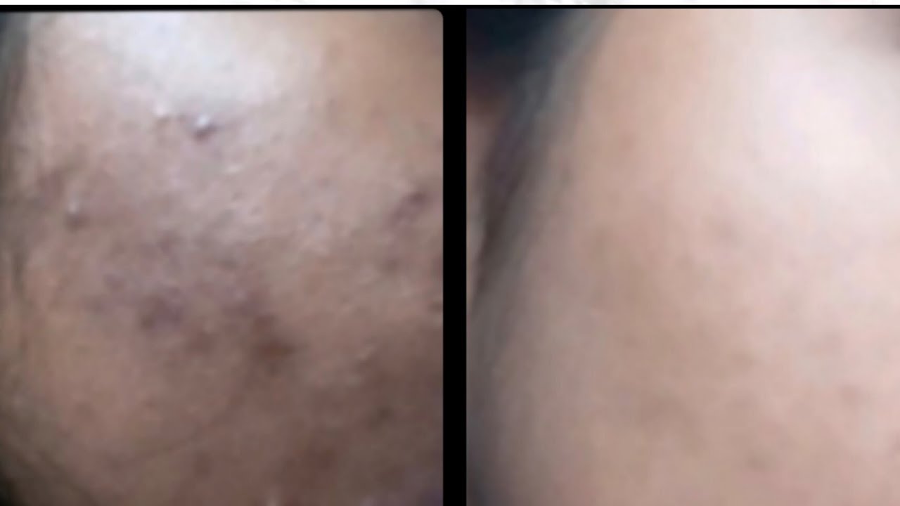 My Pregnancy Skin Care Routine Hyperpigmentation Acne What Jhumka my-pregnancy-skin-care-routine-hyperpigmentation-acne-what-jhumka