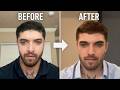 The Hardmaxx Surgeries that CHANGED MY LIFE