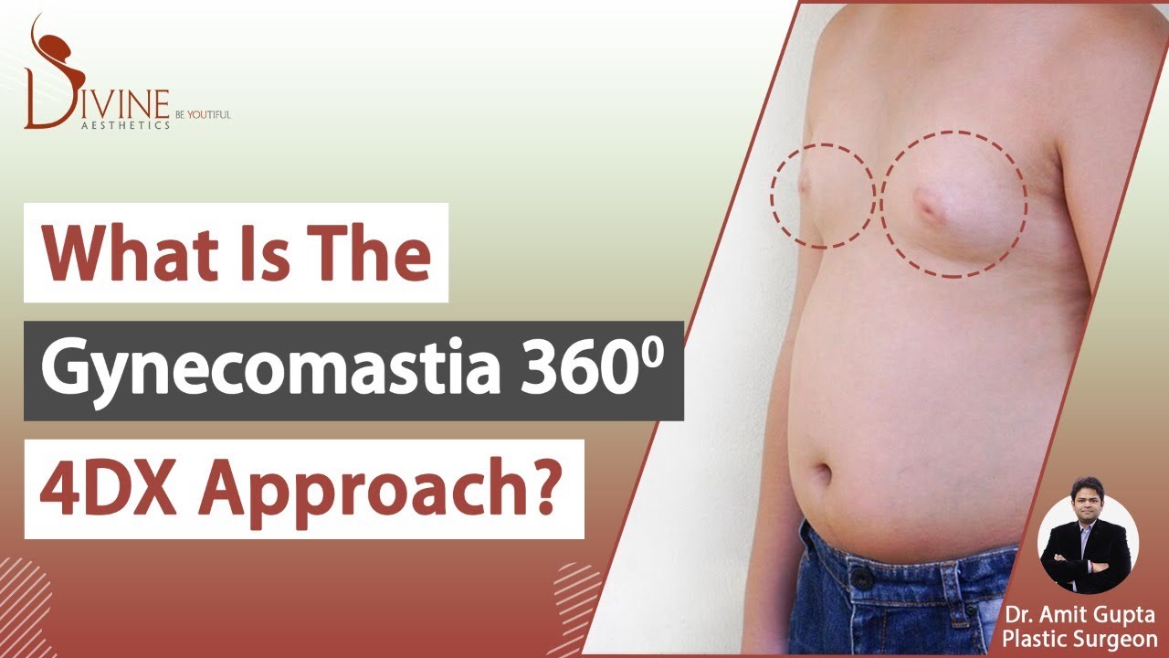 What is the Gynecomastia 360 Degree 4DX Approach? - YouTube