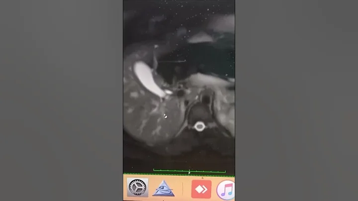 Rare case # Ectopic pregnancy in liver