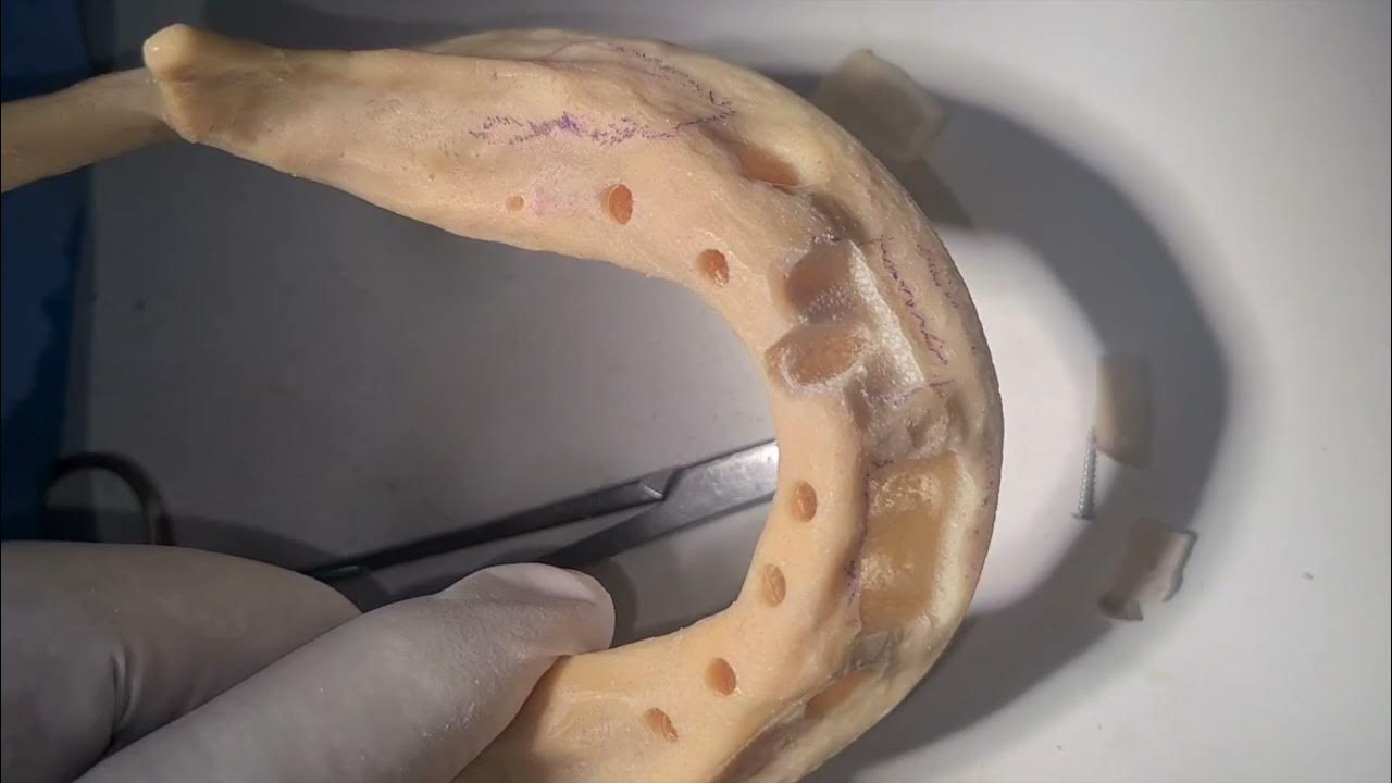 Bone Grafting Block and Khoury Graft Schematic.... YouTube