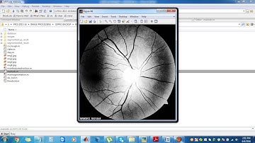 Sparse Dissimilarity-Constrained Coding for Glaucoma Scre|Best MATLAB Project institute in bangalore