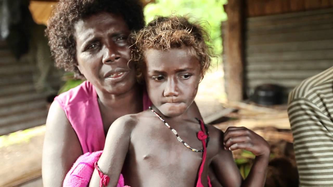 Minor Genetic Quirk Causes Melanesian Solomon People S Blond Hair