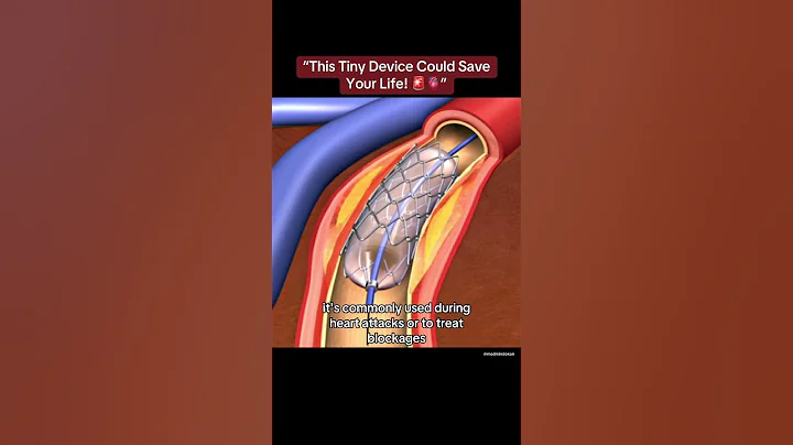 “This Tiny Device Could Save Your Life! 🚨🫀” #shorts