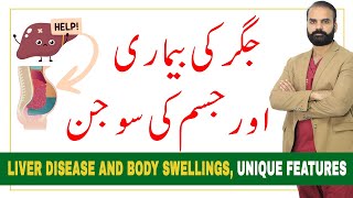 Liver Diseases and Body Swelling - Causes & Symptoms - Urdu/Hindi