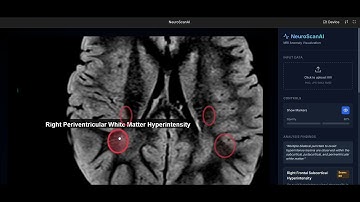 NeuroScanAI to detect anomalies in brain MRI (Gemini 3 Pro in AI Studio)