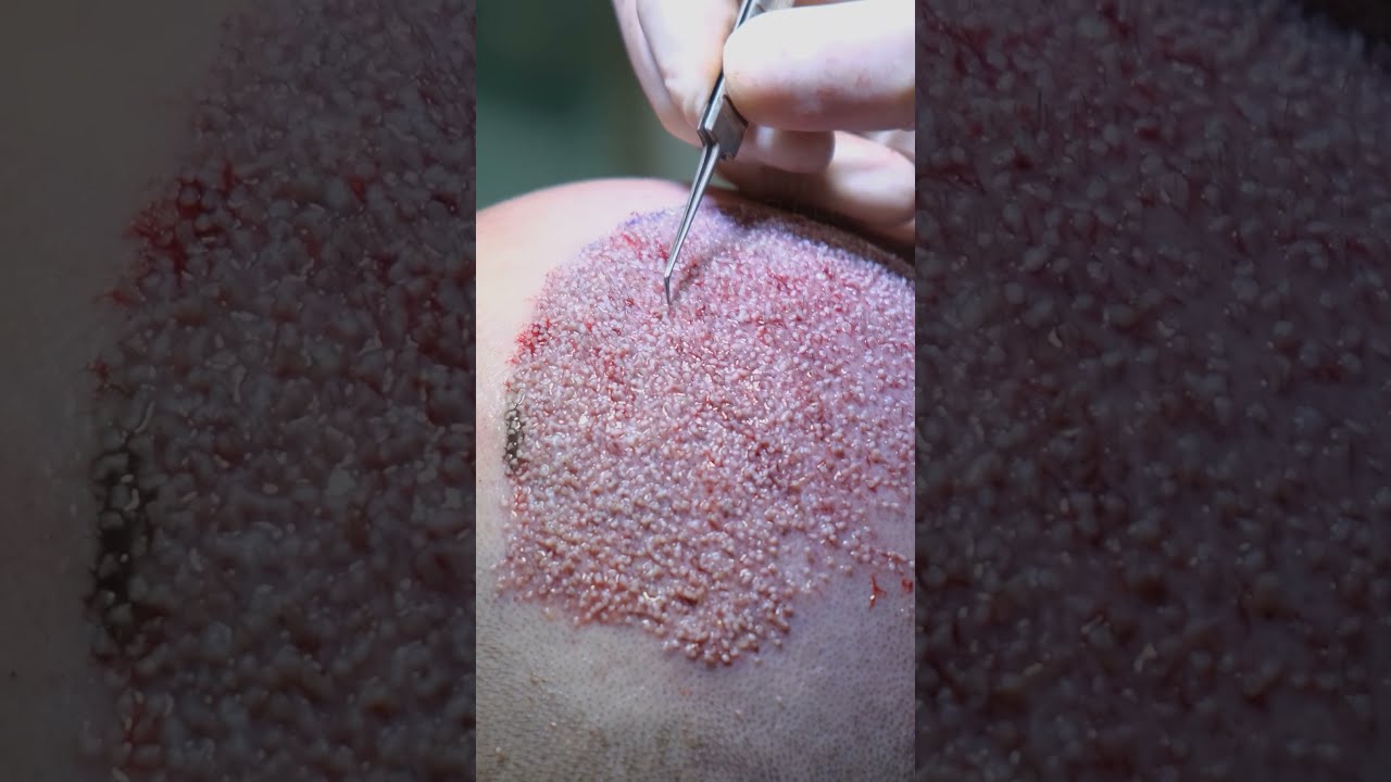 HAIR TRANSPLANT DAY OF A PATIENT