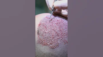 HAIR TRANSPLANT DAY OF A PATIENT