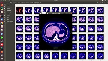 Kidney Tumor Segmentation and Classification using U-Net, ResNet, PyTorch (KiTS19) | +91-9872993883