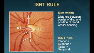 The 5 Rs of Examining the Optic Disc (Malik Y. Kahook, MD)