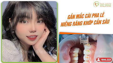Gắn mắc cài pha lê niềng răng khớp cắn sâu - KH N.T Nhung
