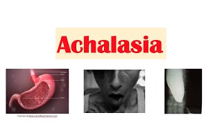 Achalasia | Pathophysiology, Causes, Signs & Symptoms, Diagnosis, Treatment
