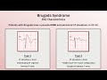 Advanced EKGs - Sudden Cardiac Death (Hypertrophic cardiomyopathy, ARVD, Brugada syndrome, and CPVT)