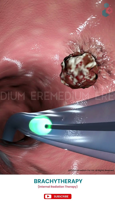 Know About Brachytherapy ↪ 3D Medical Animation #Brachytherapy #InternalRadiationTherapy