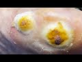 Pedicure Tutorial  The Unstressed Plantar Wart Trimming Process!