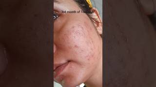 Watch this before using Tretinoin| unbelievable 💯 ||Worst to Best 🤞 screenshot 5