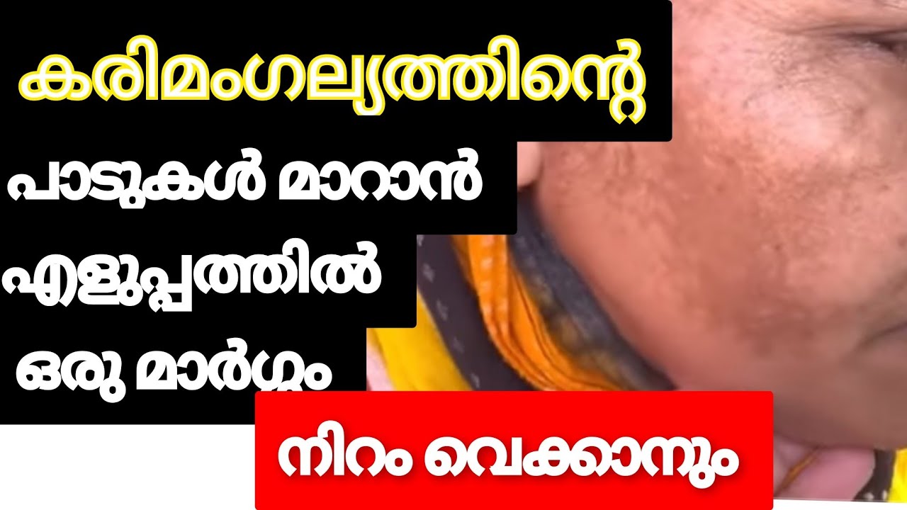 എത്ര പഴക്കമുള്ള കരിമംഗല്യം ആണെങ്കിലും പൂർണ്ണമായും മാറ്റാം 
