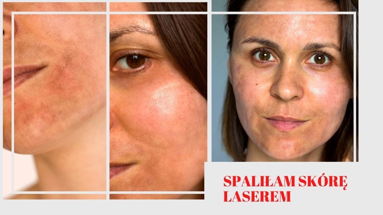 Laser Frakcyjny vs Radio RF - VLOG - TO BOLI!!  ODDNOVA Skóry | Jak długo się goi skóra?