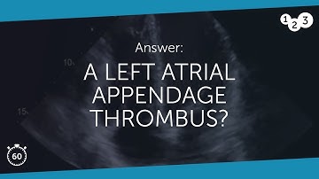 60 Seconds of Echo Teaching Answer: A left atrial appendage thrombus?